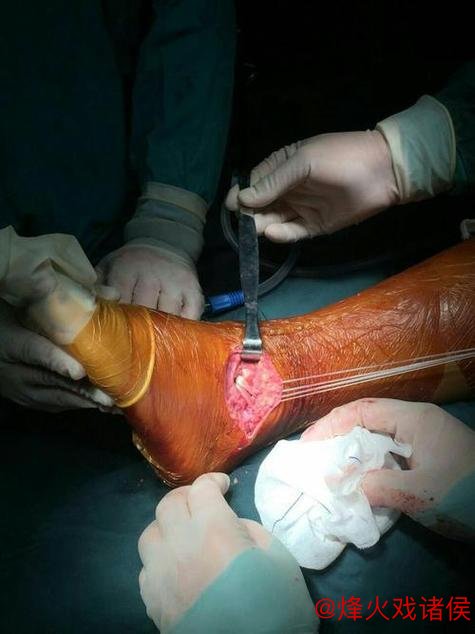 林孝天重创！右踝韧带撕裂并伴右侧腓骨骨折