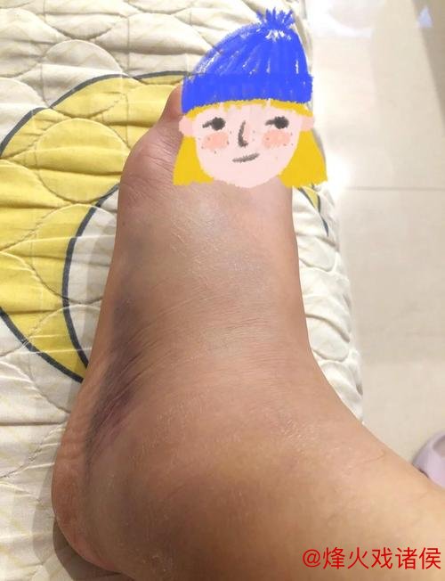 林孝天重创！右踝韧带撕裂并伴右侧腓骨骨折